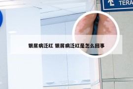 银屑病泛红 银屑病泛红是怎么回事