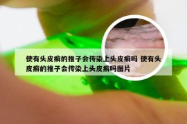 使有头皮癣的推子会传染上头皮癣吗 使有头皮癣的推子会传染上头皮癣吗图片