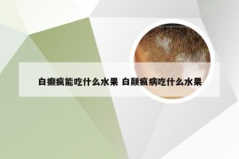 白癫疯能吃什么水果 白颠疯病吃什么水果