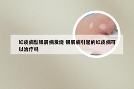 红皮病型银屑病发烧 银屑病引起的红皮病可以治疗吗