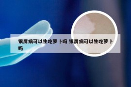 银屑病可以生吃萝卜吗 银屑病可以生吃萝卜吗