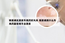 银屑病无激素外用药好大夫 银屑病用什么外用药最管用不含激素