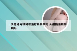 头孢磋亏钠可以治疗银屑病吗 头孢能治银屑病吗