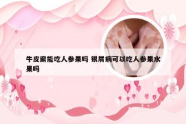 牛皮廨能吃人参果吗 银屑病可以吃人参果水果吗