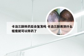 卡泊三醇停药后会复发吗 卡泊三醇用到什么程度就可以停药了