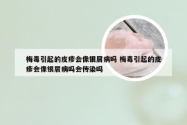 梅毒引起的皮疹会像银屑病吗 梅毒引起的皮疹会像银屑病吗会传染吗