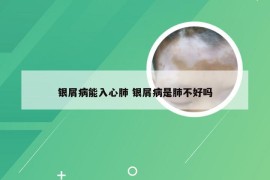 银屑病能入心肺 银屑病是肺不好吗