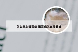 怎么患上银霄病 银霄病怎么能看好