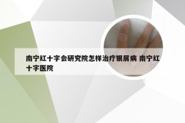 南宁红十字会研究院怎样治疗银屑病 南宁红十字医院