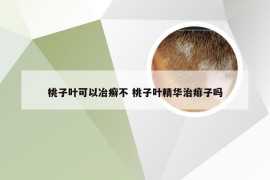 桃子叶可以冶癣不 桃子叶精华治痱子吗