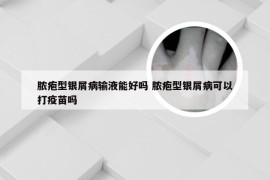 脓疱型银屑病输液能好吗 脓疱型银屑病可以打疫苗吗