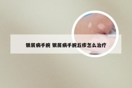 银屑病手腕 银屑病手腕丘疹怎么治疗