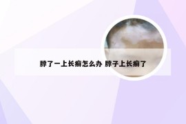 脖了一上长癣怎么办 脖子上长癣了