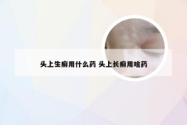 头上生癣用什么药 头上长癣用啥药