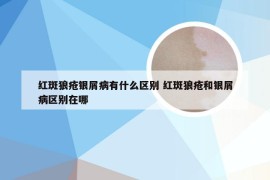 红斑狼疮银屑病有什么区别 红斑狼疮和银屑病区别在哪