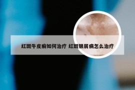 红斑牛皮癣如何治疗 红斑银屑病怎么治疗