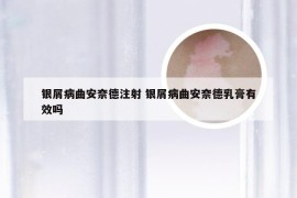 银屑病曲安奈德注射 银屑病曲安奈德乳膏有效吗