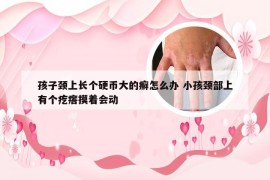 孩子颈上长个硬币大的癣怎么办 小孩颈部上有个疙瘩摸着会动