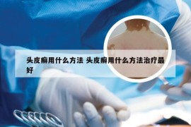 头皮癣用什么方法 头皮癣用什么方法治疗最好