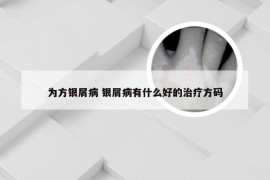 为方银屑病 银屑病有什么好的治疗方码