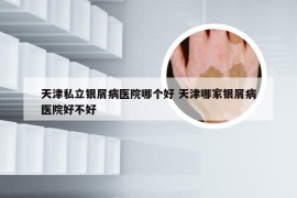 天津私立银屑病医院哪个好 天津哪家银屑病医院好不好