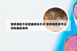 银屑病能不能做扁桃体手术 银屑病患者可以切除扁桃体吗