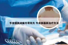 牛皮鲜民间偏方奇效方 牛皮鲜最新治疗方法