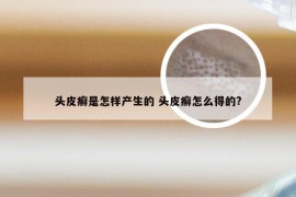 头皮癣是怎样产生的 头皮癣怎么得的?