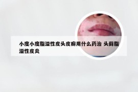 小度小度脂溢性皮头皮癣用什么药治 头藓脂溢性皮炎