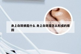 身上白斑病是什么 身上白斑是怎么形成的原因