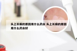 头上长癣的原因用什么药水 头上长癣的原因用什么药水好