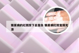 银屑病的红斑按下去变白 银屑病红斑变得光滑