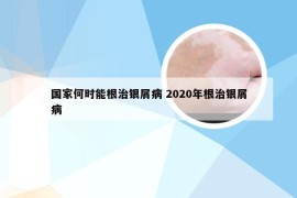 国家何时能根治银屑病 2020年根治银屑病