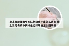 身上出现像癣中间红色边缘干皮怎么回事 身上出现像癣中间红色边缘干皮怎么回事啊