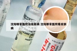 沈阳哪家医院治皮肤病 沈阳那家医院看皮肤病