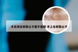 手无缘无故裂口子是不是癣 手上无故裂口子