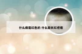 什么癣是红色的 什么藓长红疙瘩