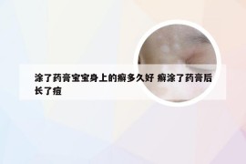 涂了药膏宝宝身上的癣多久好 癣涂了药膏后长了痘