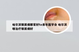 哈尔滨银屑病那家好to青年医学会 哈尔滨哪治疗银屑病好