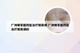 广州哪家医院能治疗银屑病 广州哪家医院能治疗银屑病的