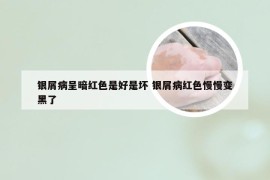 银屑病呈暗红色是好是坏 银屑病红色慢慢变黑了