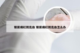 银屑病红斑出血 银屑病红斑出血怎么办