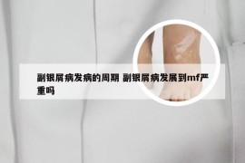 副银屑病发病的周期 副银屑病发展到mf严重吗