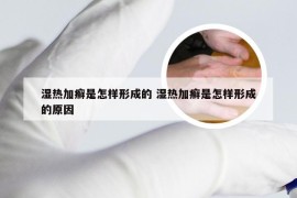 湿热加癣是怎样形成的 湿热加癣是怎样形成的原因