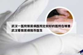 武汉一医院银屑病医院比较好的医院在哪里 武汉看银屑病推荐医生