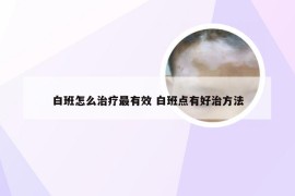 白班怎么治疗最有效 白班点有好治方法