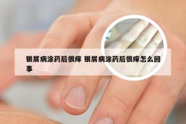 银屑病涂药后很痒 银屑病涂药后很痒怎么回事