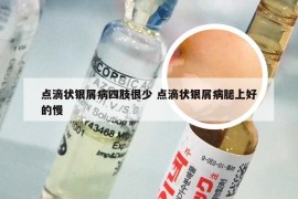 点滴状银屑病四肢很少 点滴状银屑病腿上好的慢