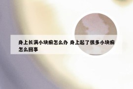 身上长满小块癣怎么办 身上起了很多小块癣怎么回事