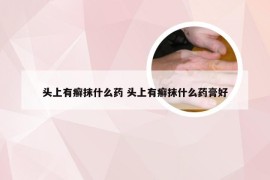 头上有癣抹什么药 头上有癣抹什么药膏好